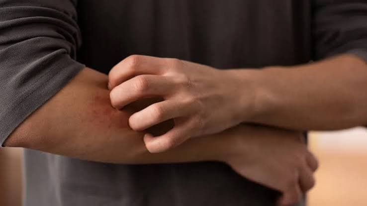 Aumento dei casi di dermatofilosi in Europa: Pregliasco rassicura, ma le modalità di trasmissione evolvono